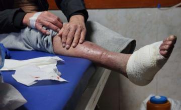 وسط إهمال طبي.. الجرب يتفشى بين أسرى فلسطينيين في سجن إسرائيلي