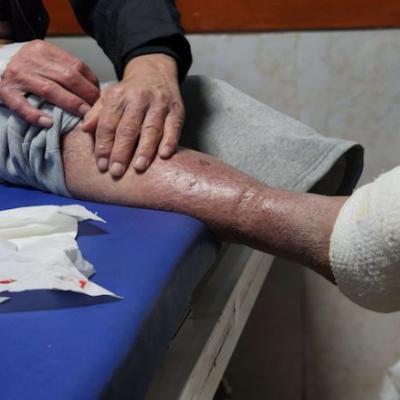 وسط إهمال طبي.. الجرب يتفشى بين أسرى فلسطينيين في سجن إسرائيلي