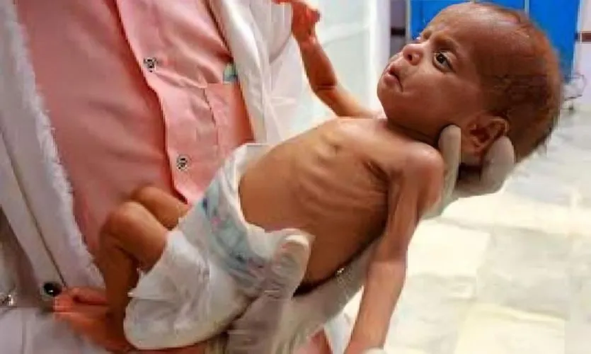 حصيلة شهداء المجاعة في غزة تصل إلى 440 بينهم 148 طفلا